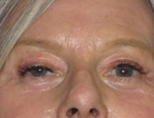 Facelift Before & After Patient #1009