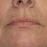 Facelift Before & After Patient #1009