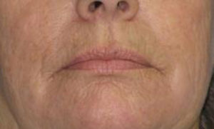 Facelift Before & After Patient #1009