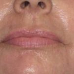 Facelift Before & After Patient #1009