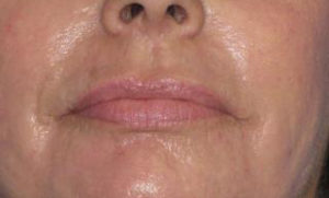 Facelift Before & After Patient #1009