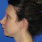 Fat Transfer to Face Before & After Patient #940