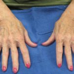 Fat Transfer Before & After Patient #973