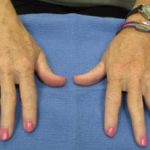Fat Transfer Before & After Patient #973
