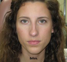 Non-Surgical Rhinoplasty Before & After Patient #775