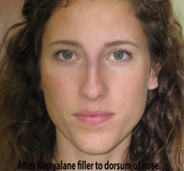 Non-Surgical Rhinoplasty Before & After Patient #775