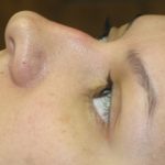 Non-Surgical Rhinoplasty Before & After Patient #780