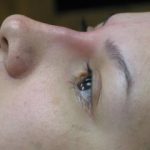 Non-Surgical Rhinoplasty Before & After Patient #780
