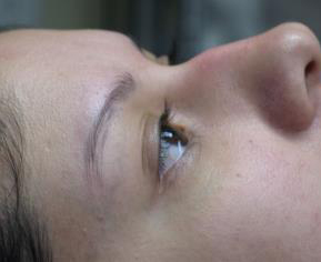 Non-Surgical Rhinoplasty Before & After Patient #780