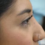 Non-Surgical Rhinoplasty Before & After Patient #787