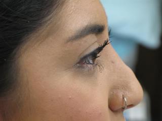 Non-Surgical Rhinoplasty Before & After Patient #787