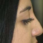 Non-Surgical Rhinoplasty Before & After Patient #787
