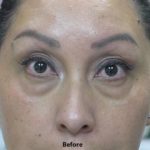 Tear Troughs Before & After Patient #649