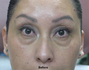 Tear Troughs Before & After Patient #649