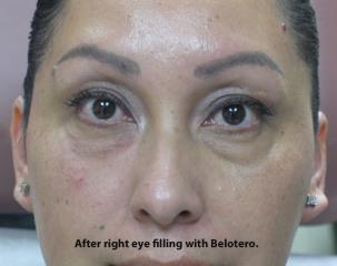 Tear Troughs Before & After Patient #649