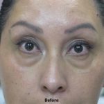 Tear Troughs Before & After Patient #649