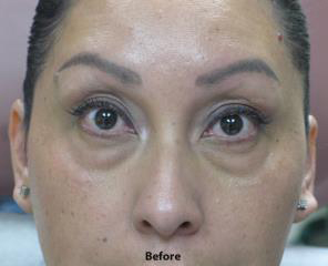Tear Troughs Before & After Patient #649