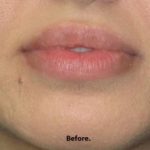 Lips Before & After Patient #692