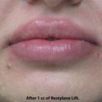 Lips Before & After Patient #692