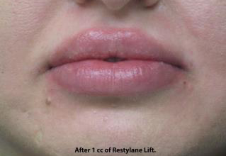 Lips Before & After Patient #692