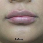 Lips Before & After Patient #698