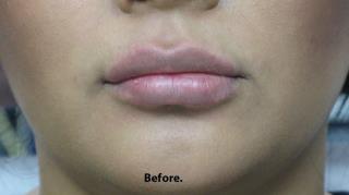 Lips Before & After Patient #698