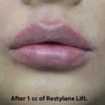Lips Before & After Patient #698