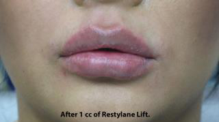 Lips Before & After Patient #698