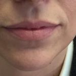 Lips Before & After Patient #720