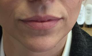 Lips Before & After Patient #720