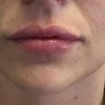 Lips Before & After Patient #720
