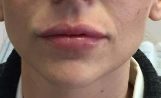 Lips Before & After Patient #720