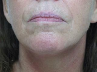 Lips Before & After Patient #726