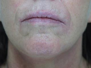 Lips Before & After Patient #726