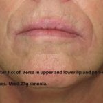 Lips Before & After Patient #729