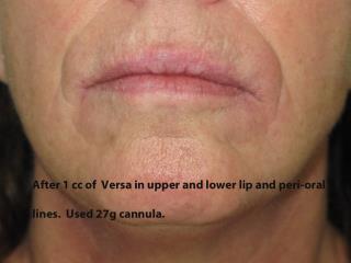 Lips Before & After Patient #729