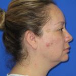 Renuvion Subcutaneous Skin Tightening Before & After Patient #1102