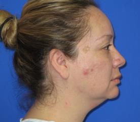 Renuvion Subcutaneous Skin Tightening Before & After Patient #1102