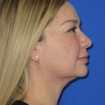 Renuvion Subcutaneous Skin Tightening Before & After Patient #1102