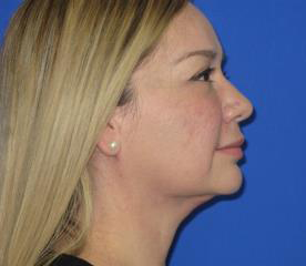 Renuvion Subcutaneous Skin Tightening Before & After Patient #1102