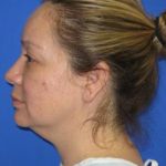 Renuvion Subcutaneous Skin Tightening Before & After Patient #1102