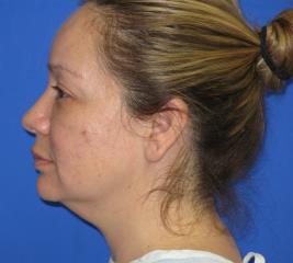 Renuvion Subcutaneous Skin Tightening Before & After Patient #1102