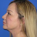 Renuvion Subcutaneous Skin Tightening Before & After Patient #1102