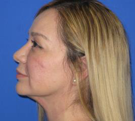 Renuvion Subcutaneous Skin Tightening Before & After Patient #1102