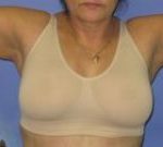 Liposuction Before & After Patient #1109