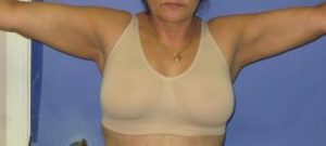 Liposuction Before & After Patient #1109