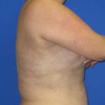 VASER Liposuction Before & After Patient #1116