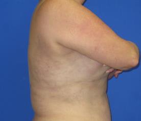 VASER Liposuction Before & After Patient #1116