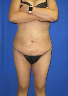 VASER Liposuction Before & After Patient #1123