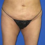 VASER Liposuction Before & After Patient #1123
